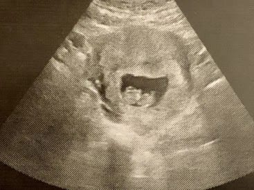 My ultrasound