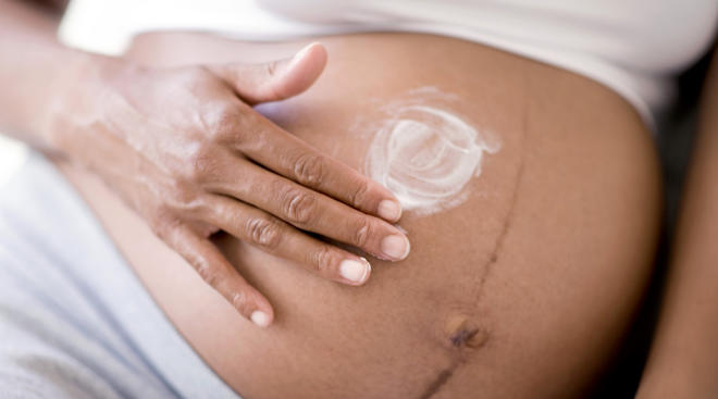 10 Home Remedies to Reduce Your Stretch Marks After Pregnancy